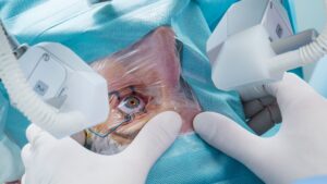 Types of Cataract Surgery: Which one is Best for You?
